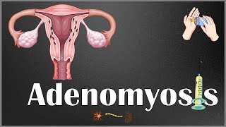 Adenomyosis : Definition, Causes, Risk Factors, Signs & Symptoms, Diagnosis & Treatment