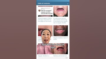 #angularcheilitis or rash in the corners of your mouth, have a variety of causes and fixes