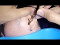 Removing huge earwax stuck in womans ear