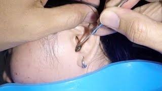 Removing Huge Earwax Stuck in Woman's Ear