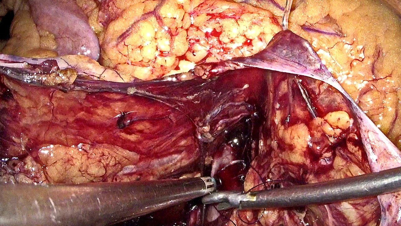 Laparoscopic Management of Inferior Vena Cava Injury - YouTube