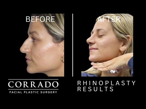 Video thumbnail: Rhinoplasty Results One Week After Surgery | Dr. Anthony Corrado · Dr. Anthony Corrado