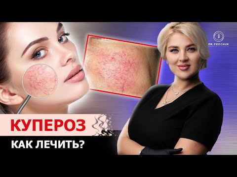 Как избавиться от сосудов на лице? Советы врача - косметолога