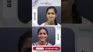 1 Year After Cleft Rhinoplasty + Jaw Surgery | Before &amp; After Result | Dr Mathew PC