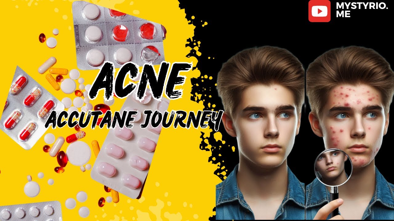 My Accutane Journey ! Pimple and Acne best treatment - YouTube
