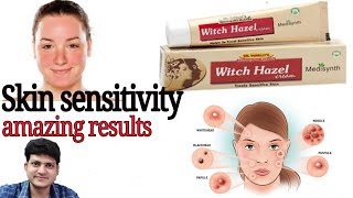 Homeopathic Cream for Skin sensitive ? sensitive skin की होम्योपैथिक दवा |