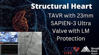 TAVR with 23mm SAPIEN-3 Ultra Valve with LM Protection