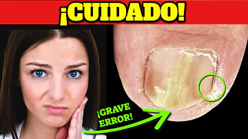 ¿Cuánto tiempo se tarda en eliminar la onicomicosis?