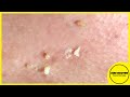 Suri Job 87: AWESOME BIG BLACKHEADS