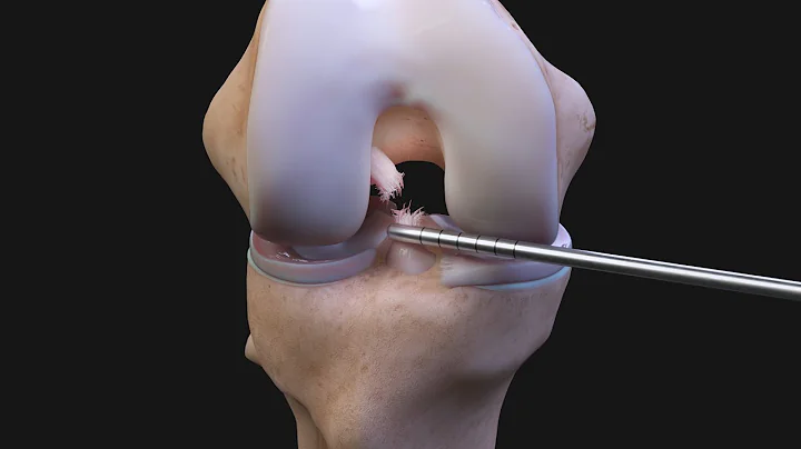 ACL Reconstruction FAQs ACLTear.com