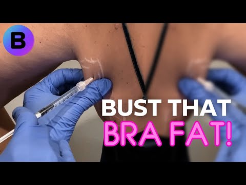 BodyFix: Kybella