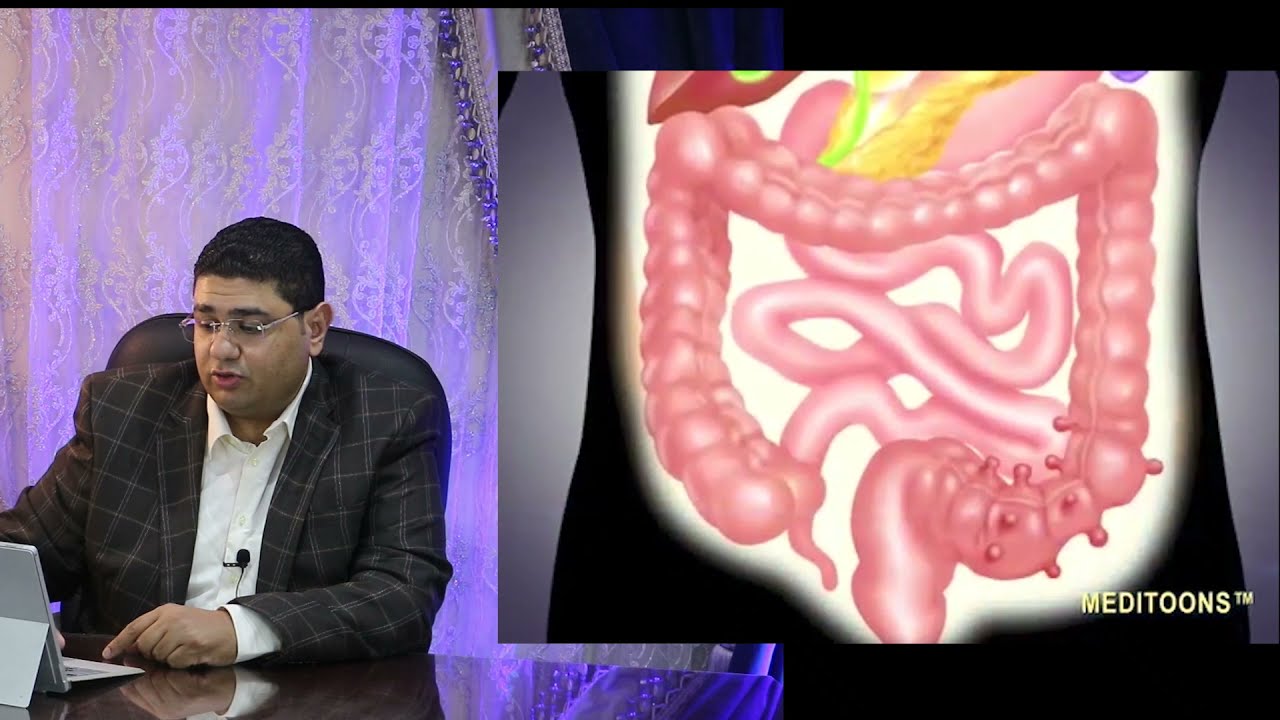 Diverticulosis جيوب القولون