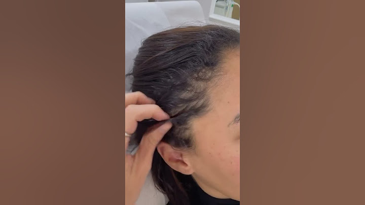 QUEDA DE CABELO