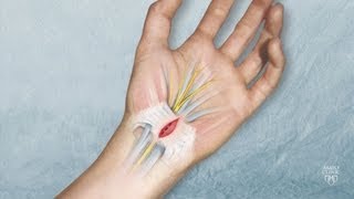 New approaches to carpal tunnel release and treatment of tendinopathy -  Mayo Clinic