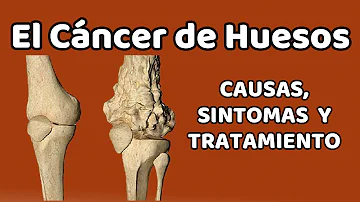 ¿Es el cáncer de huesos el más doloroso?