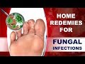 How to Cure Fungal Infection Using Home Remedies