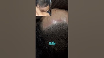 Hói chữ m thì phải làm sao?? Xăm chân tóc thôi #xămtóc #scalp #smp