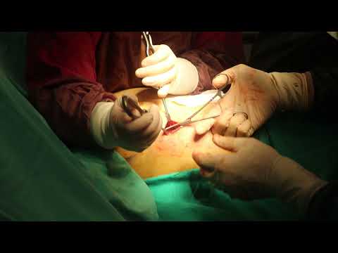 Doç. Dr. Erkan Yıldırım - Pektus Bar Çıkarma Ameliyatı #PektusKarinatum #PektusEkskavatum