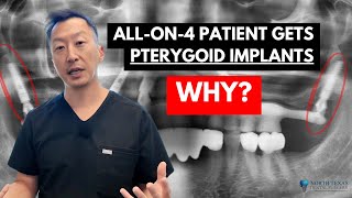 Pterygoid implants for All on 4 dental implant smile makeovers