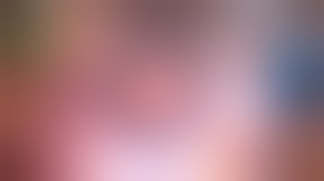 Traumatic Dislocated IOL, Haptic in AC, Vitrector PI, IOL Exchange Kim Modified Yamane Technique