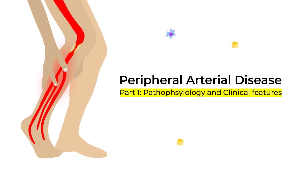 Peripheral Arterial Disease - Part 1: Pathophysiology & Clinical features  شرح بالعربى