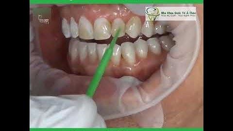 Quy trình bọc răng sứ không mài răng, có thể bạn chưa biết