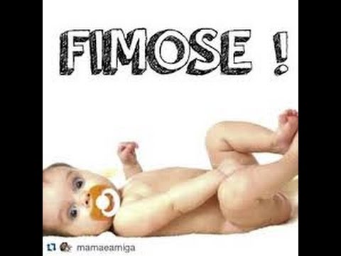 Meninos Quando E Como Tratar A Fimose Youtube