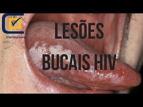 Vídeo: Feridas Na Boca Por HIV: Como Elas São E Como Tratá-las