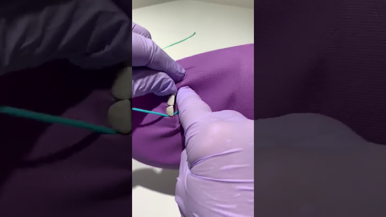 Wedjets Cord Isolation for tight contacts