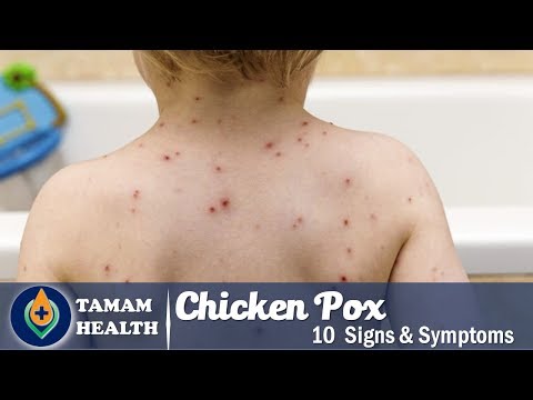 10 Signs and Symptoms of Chicken Pox