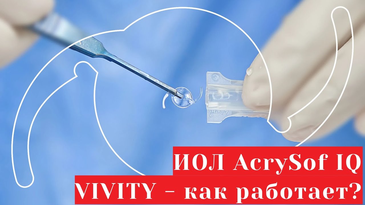 Acrysof iq panoptix. линза интраокулярная sa60at acrysof. Acrysof iq vivity. иол vivity alcon. Acrysof iq vivity.