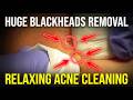 Huge Blackheads Removal Relaxing Acne Cleaning