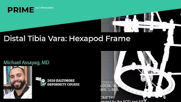 Distal Tibia Vara: Hexapod Frame - Michael Assayag, MD