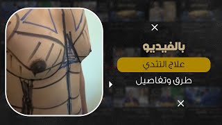 تفاصيل طرق علاج التثدي مع د. شريف حجازي