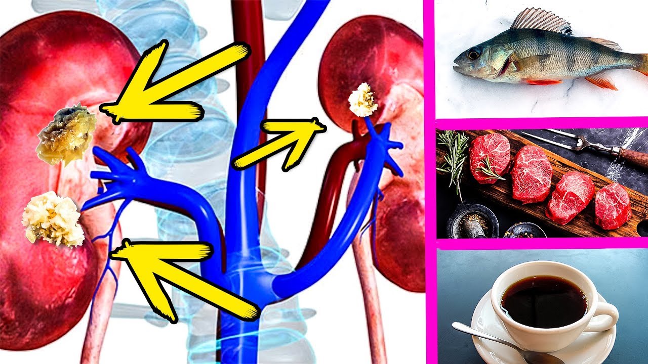 Эти продукты способствуют образованию Камней в почках. Сведи их к минимуму