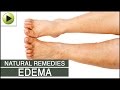 Edema - Natural Ayurvedic Home Remedies