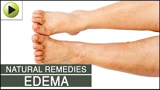 Edema - Natural Ayurvedic Home Remedies