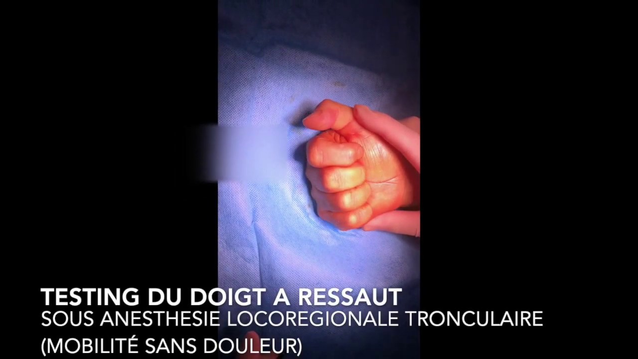 Chirurgie du doigt à ressaut et du kyste de poulie - Dr Falcone