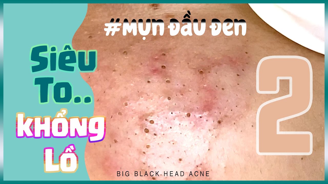 Big Cystic Acne Blackheads Extraction Blackheads & Milia, Whiteheads Removal Pimple Popping