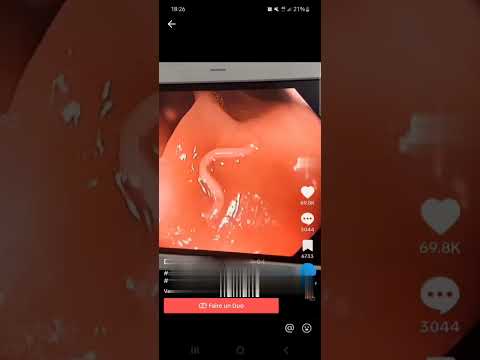 قولون مصاب بالطفيليات الديدان