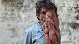 Download lagu India s Elephant Man MP3 India s Elephant Man