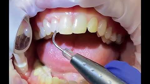 Laser Bacterial Reduction with the Biolase Epic Hygiene Diode Laser