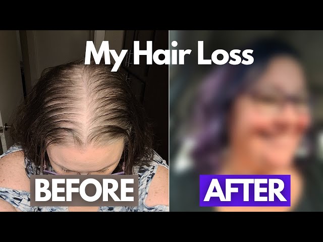 tirzepatide and hair loss I Cut Off My Hair - My Mounjaro Hair Loss Journey | Tirzepatide Week 18