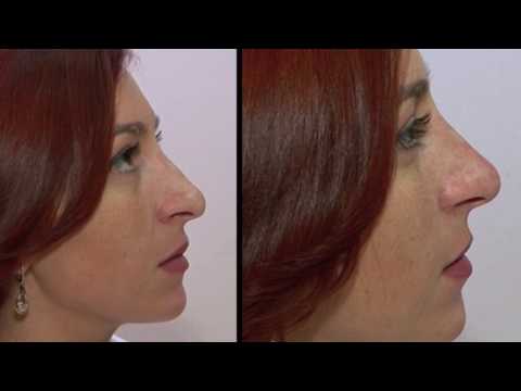 ცხვირის კორექცია ოპერაციის გარეშე (უსისხლო რინოპლასტიკა)