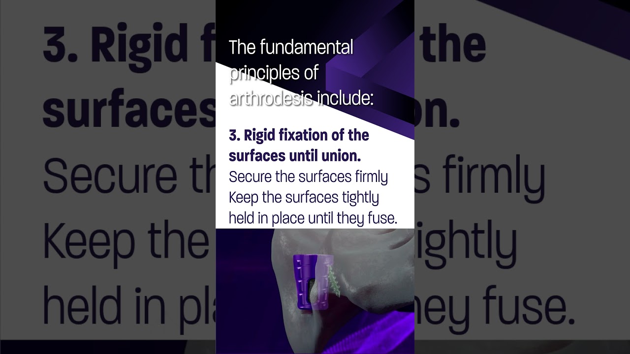 SiLO TFX™ follows the AO Principles for arthrodesis. Check out the video! 