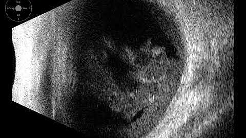 20 MHz Annular Ophthalmic Ultrasound ABSolu, Intragel and subhyaloid hemorrhage, 36770