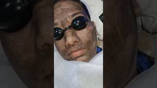 Say Goodbye to Pigmentation | Best Treatment for Dark Spots &amp; Melasma Results #PigmentationTreatment
