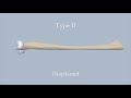 Mason Classification of Radial Head Fractures