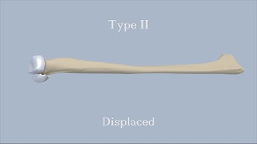 Mason Classification of Radial Head Fractures