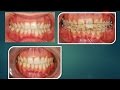 Leveling GUM with Orthodontics!!!